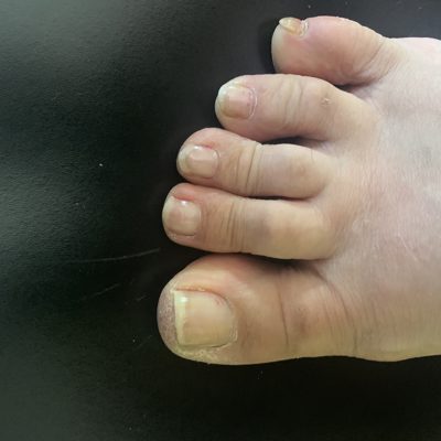 supertoe