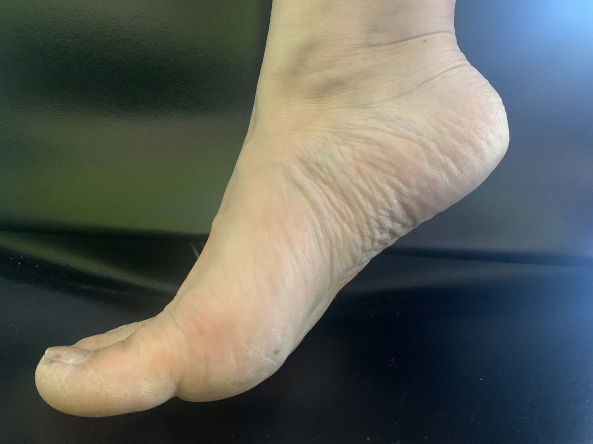 supertoe